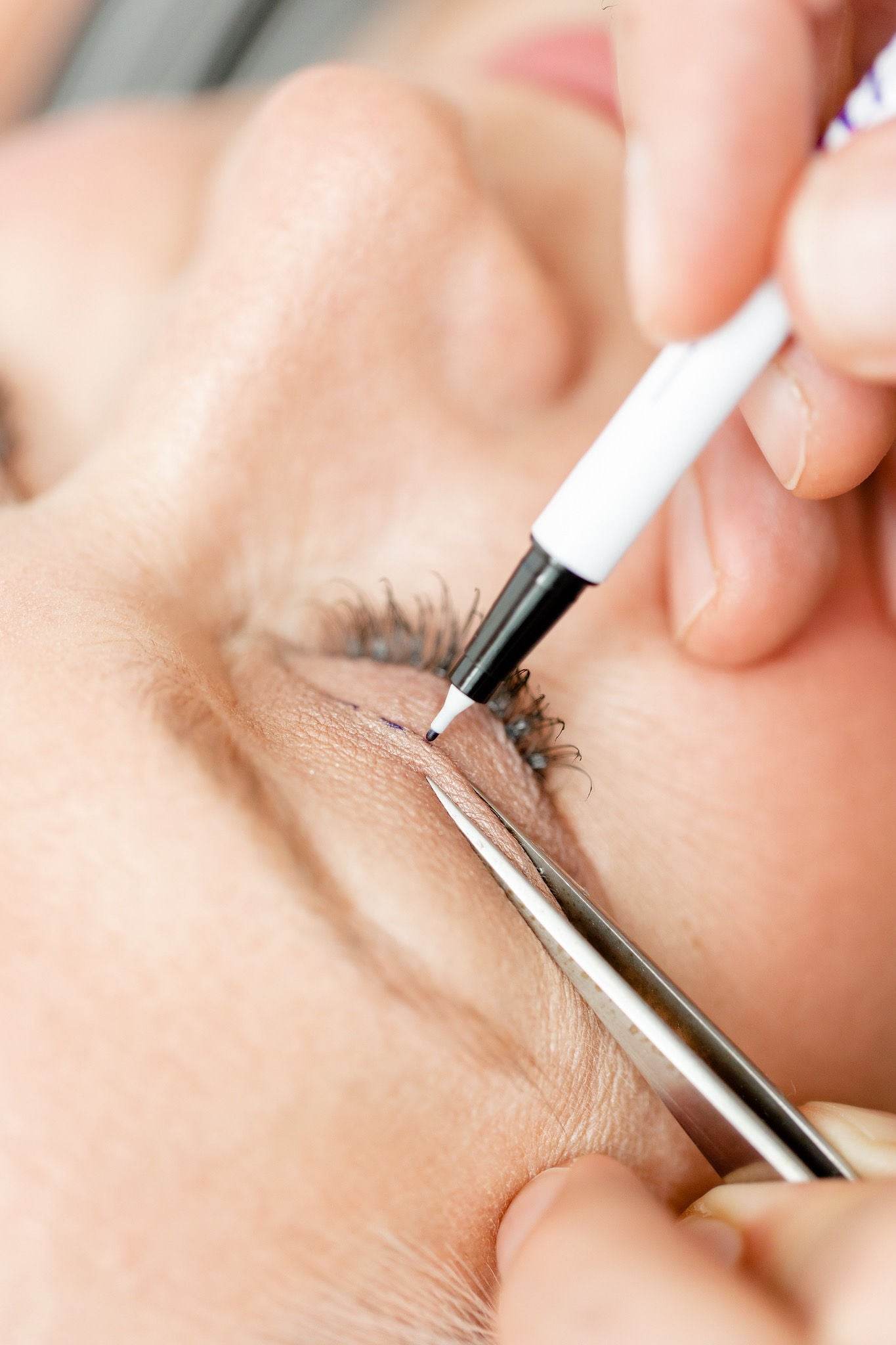 Close-up of eyelid surgery marking with a surgical pen, preparing for precise blepharoplasty procedure by Dr. Babak Maleki