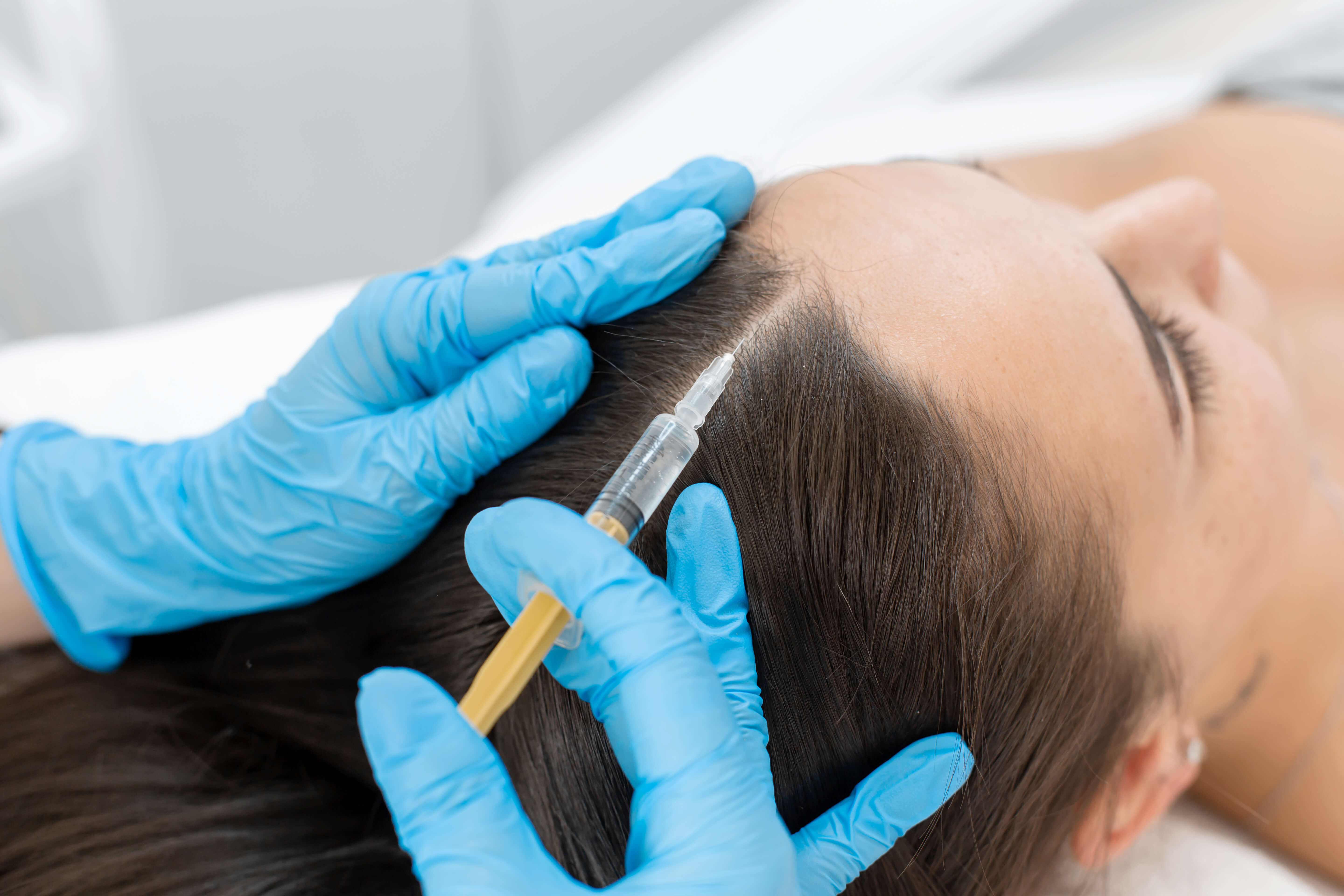 Hair PRP treatment – platelet-rich plasma being injected into the scalp to stimulate hair growth