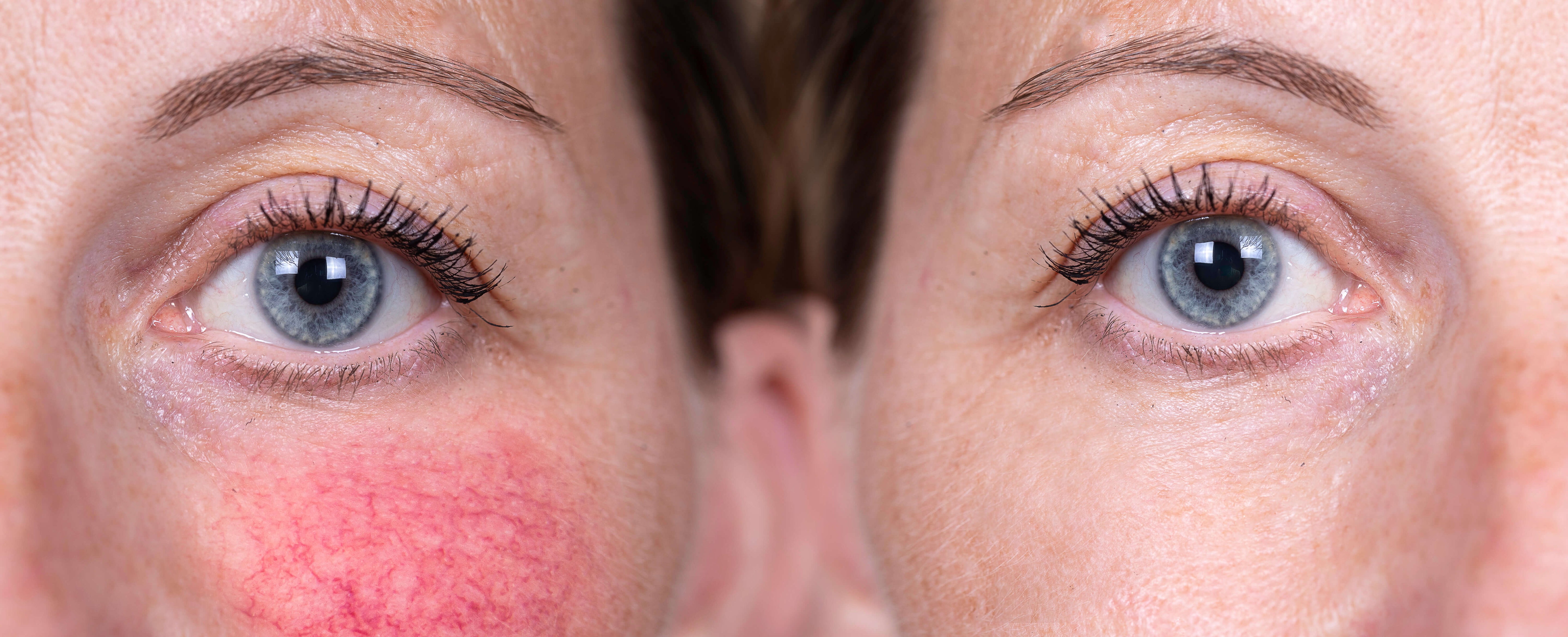 Close-up of a woman’s face showing vascular redness on left cheek before treatment and clear skin after IPL treatment