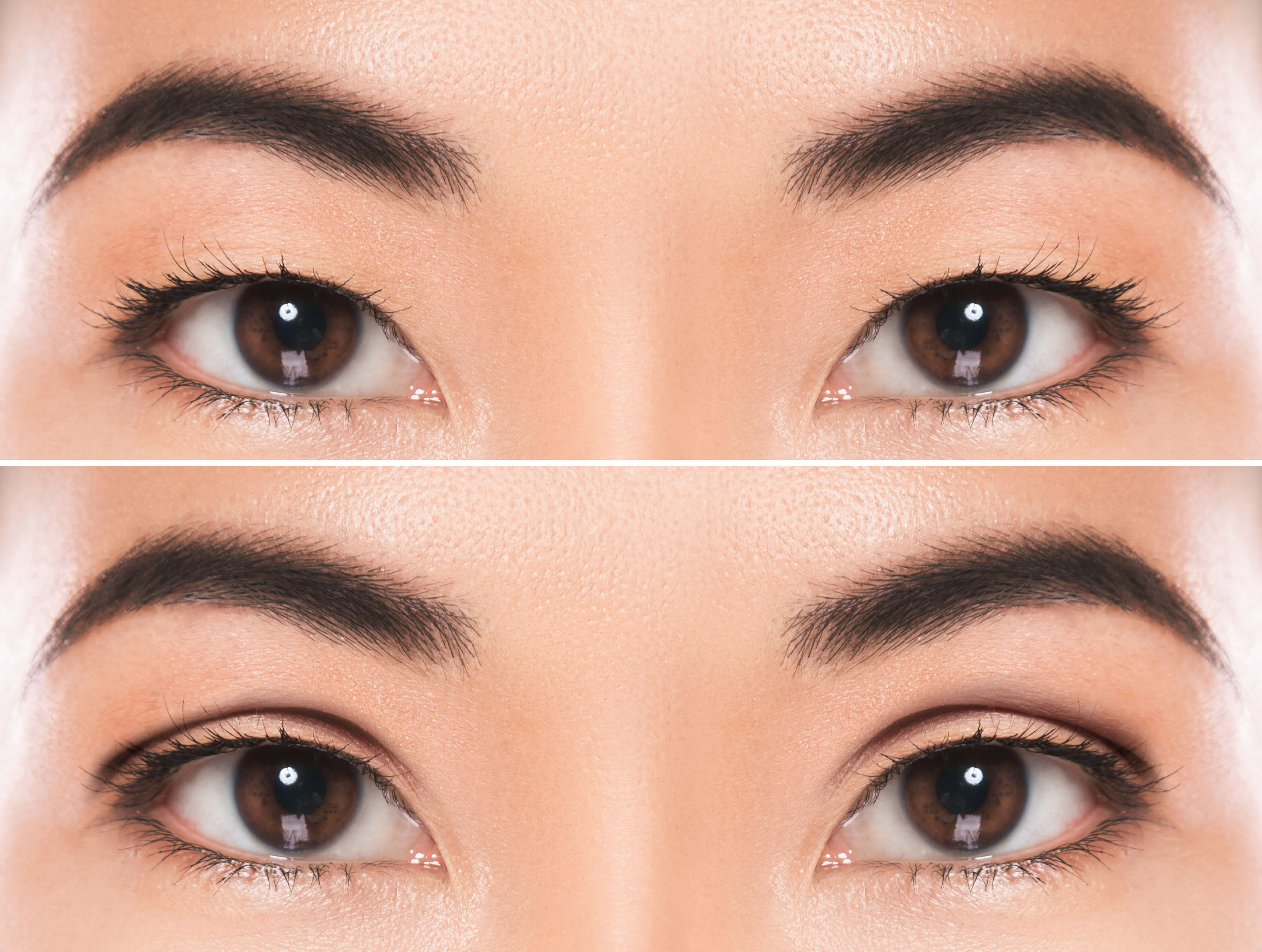 Before and after results of double eyelid surgery, enhancing eyelid crease and eye symmetry