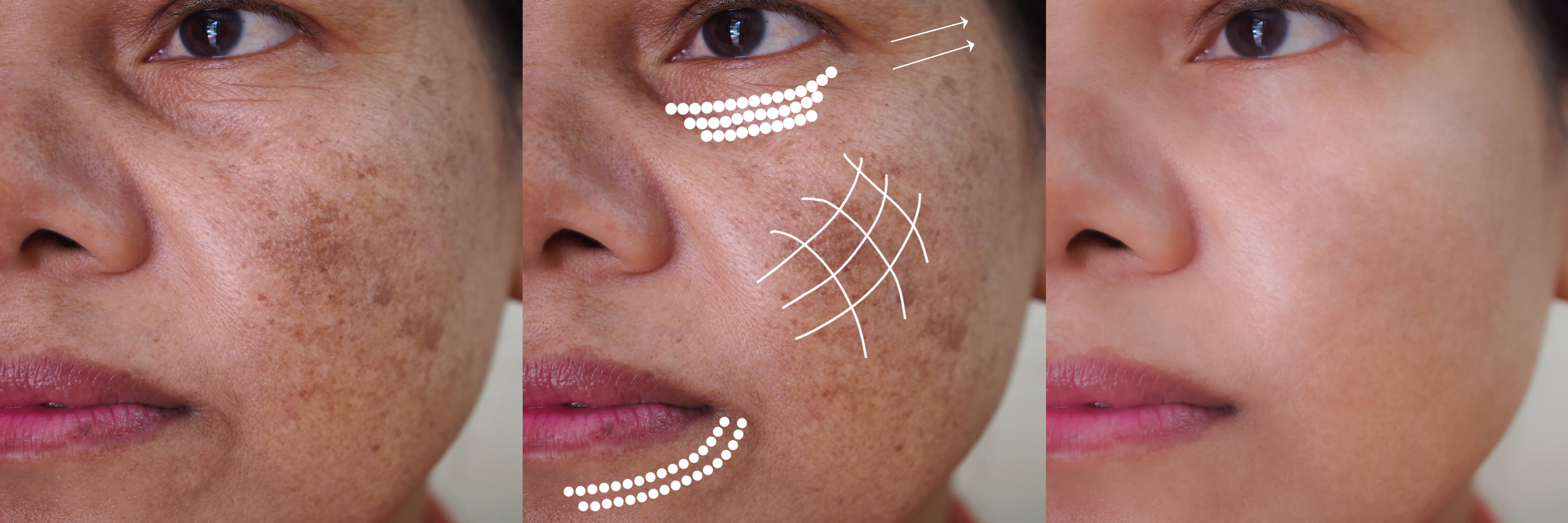 Progression of facial skin treatment showing dark spots and hyperpigmentation before, during marked treatment zones, and after clear skin results