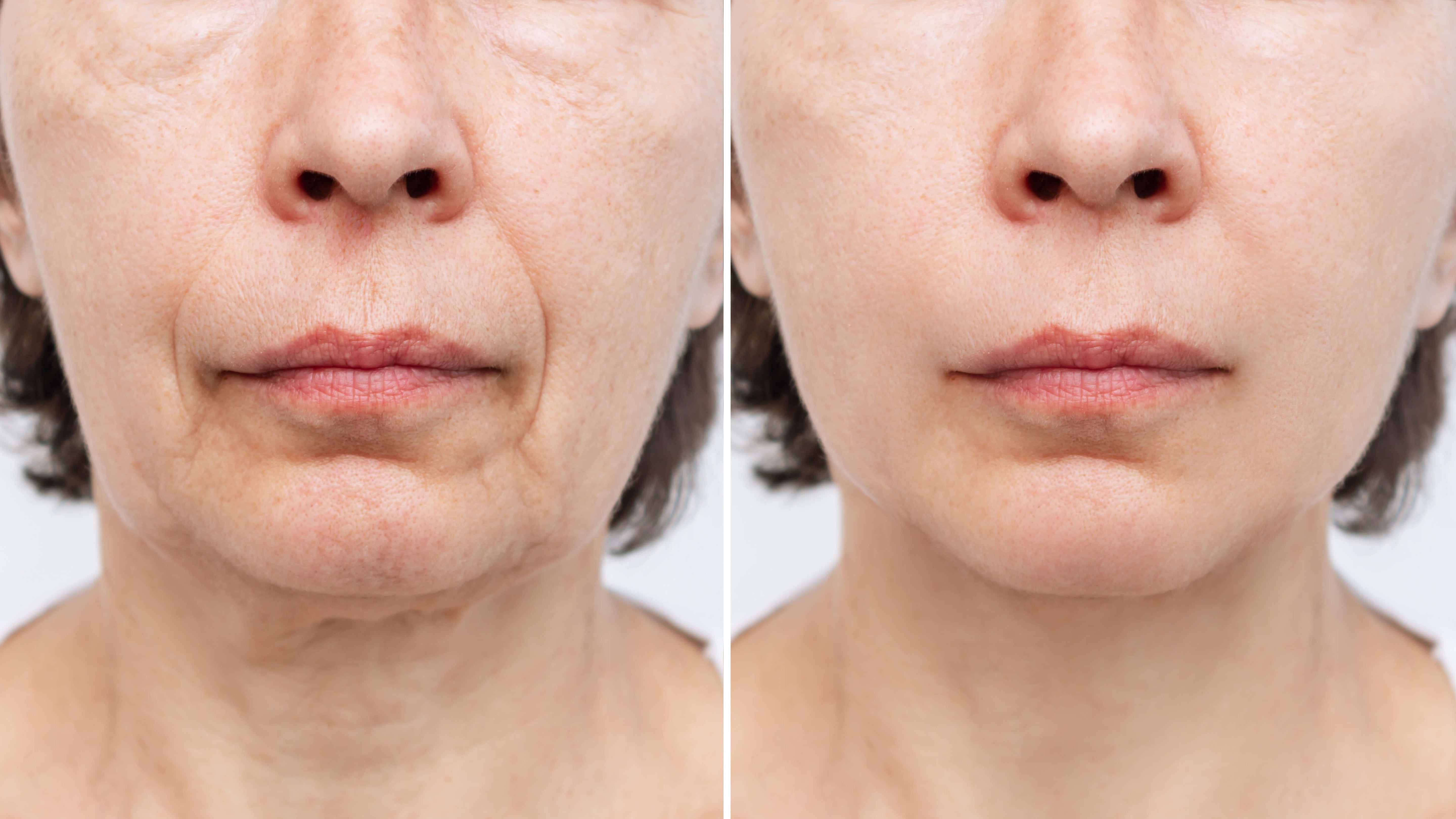 Before and after close-up of lower face showing visible improvement in wrinkles and skin firmness