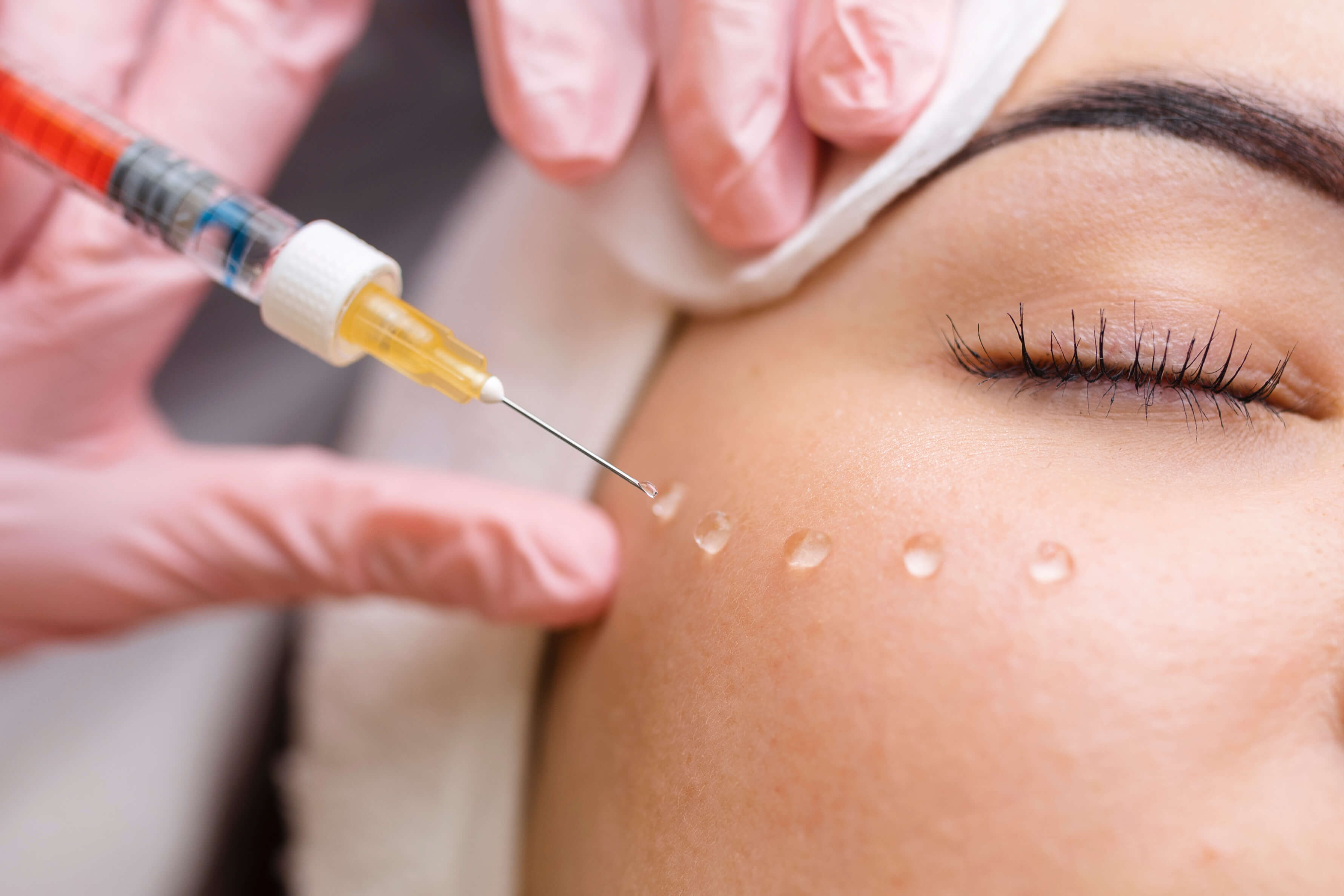 Dermal filler injections being applied to the cheek area using microdroplet technique by practitioner in pink gloves