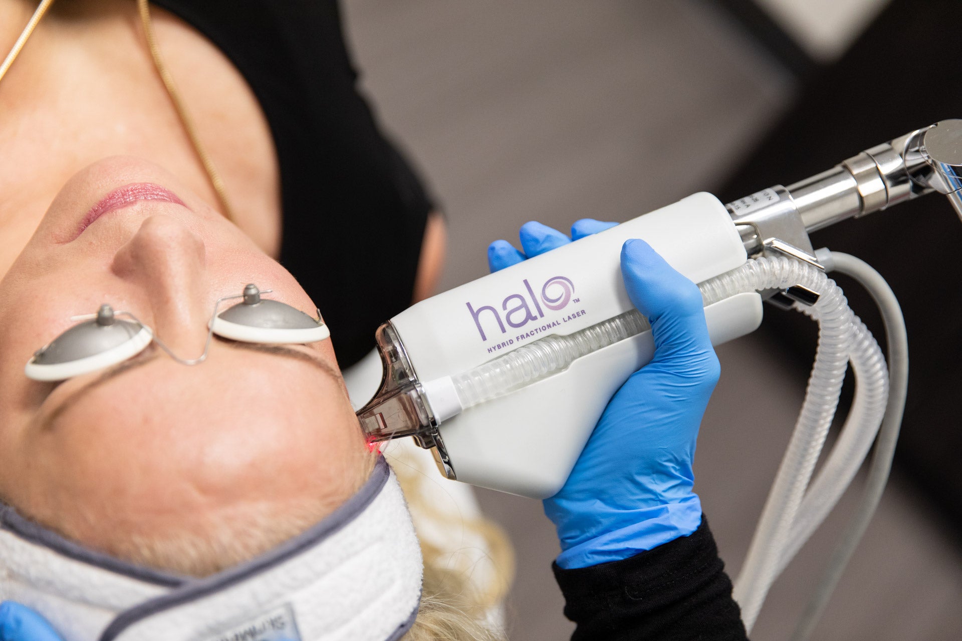 Woman undergoing HALO® laser skin resurfacing treatment – advanced hybrid fractional laser therapy for rejuvenation