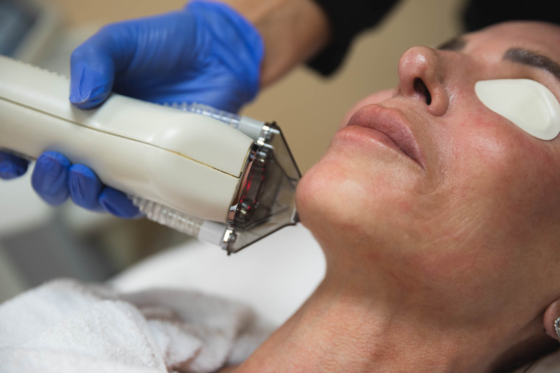 Close-up of a woman receiving HALO® laser skin resurfacing treatment on her face, performed by a provider wearing blue gloves