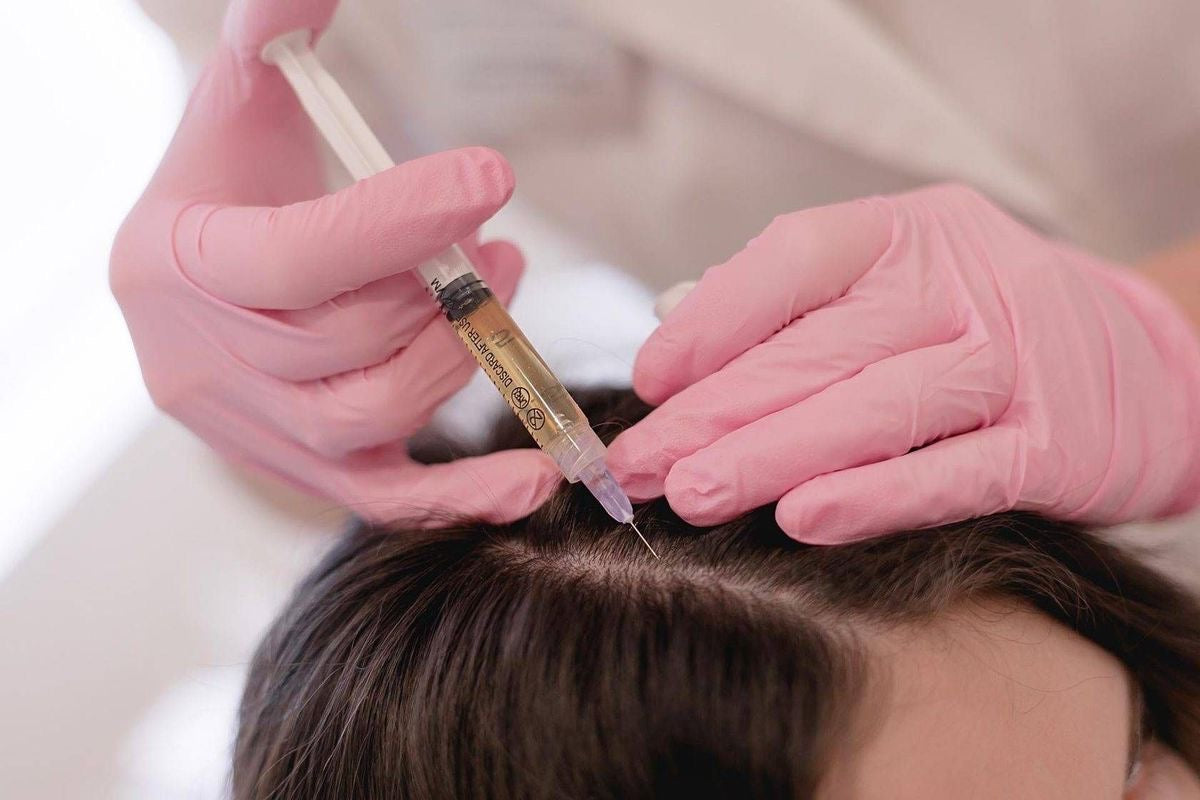 Hair PRP treatment – platelet-rich plasma being injected into the scalp to stimulate hair growth